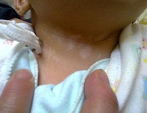 婴幼儿白癜风的早期症状是什么