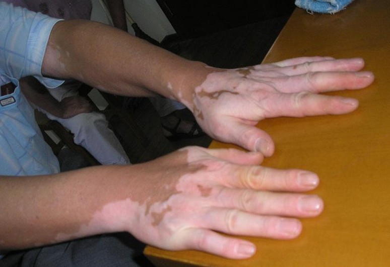 手部白癜风治疗难的病因有哪些